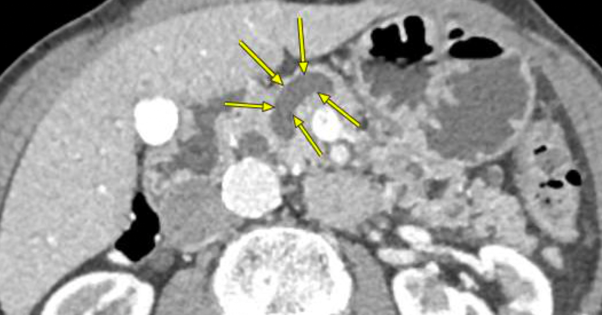 Leading In The Treatment Of Pancreatic Cysts 2192